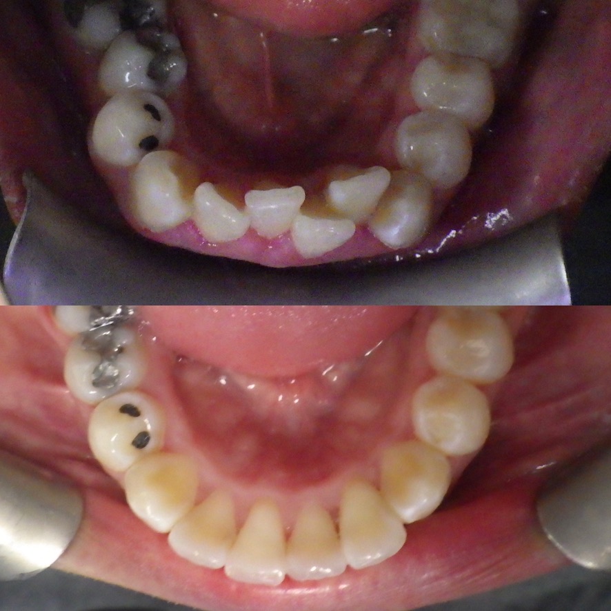 before and after Hawthorne CA