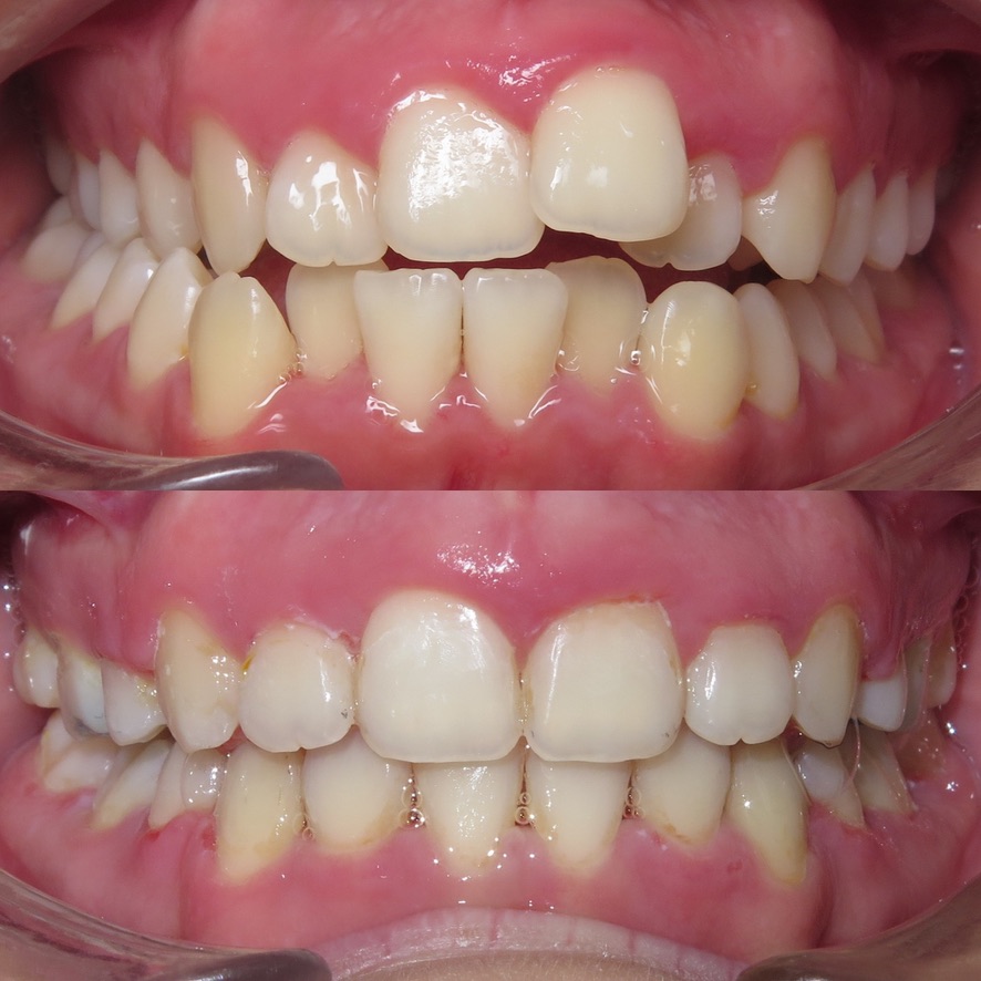 Veneer and whitening smile transformation
