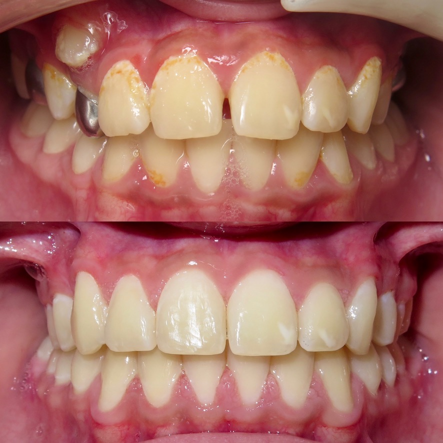Veneer and whitening smile transformation