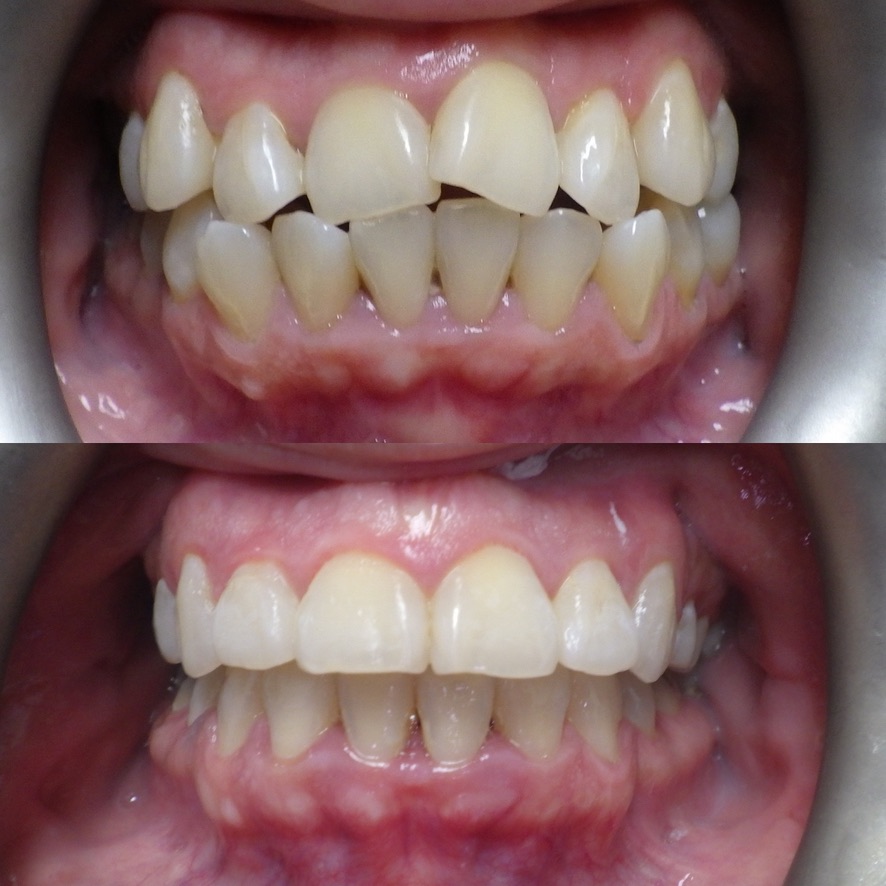 Veneer and whitening smile transformation