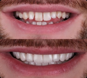 Invisalign before and after Hawthorne CA