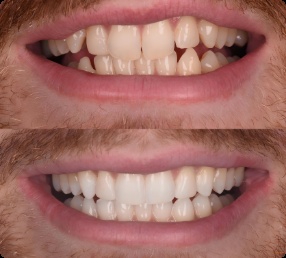 Ceramic braces before and after Hawthorne CA