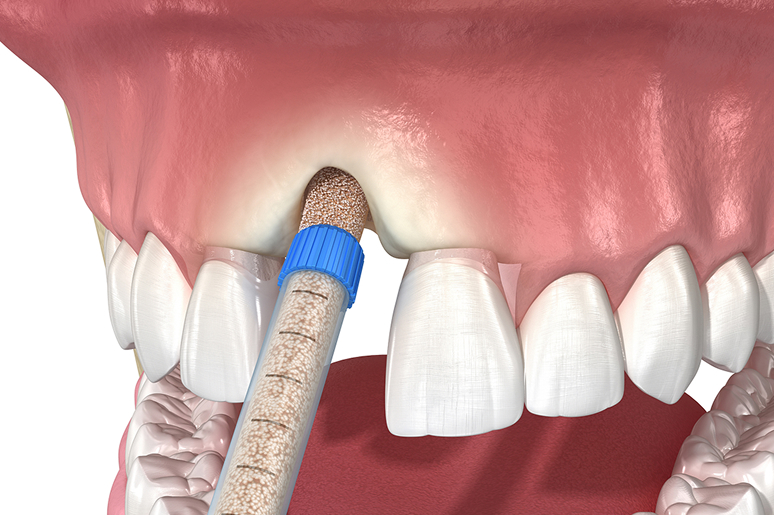 Bone grafting for dental implants Hawthorne CA
