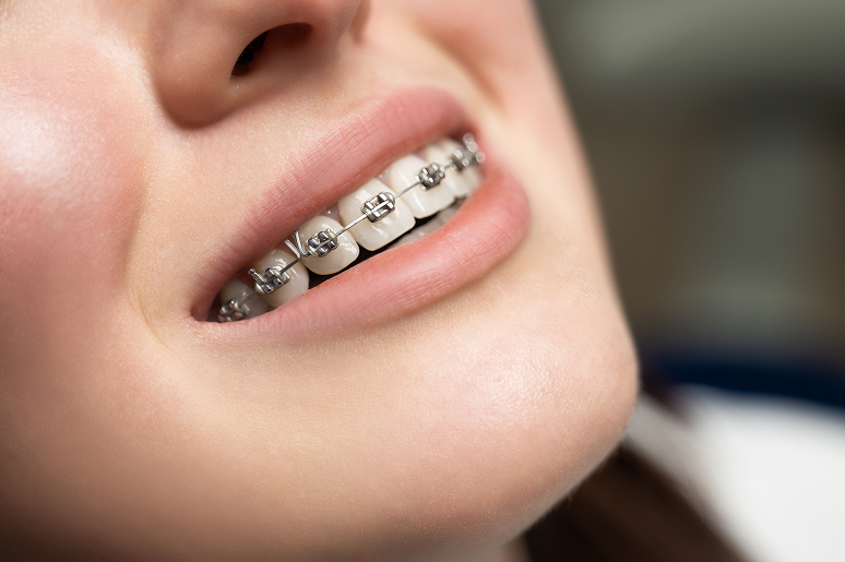 Ceramic braces at Trusted Dental Hawthorne