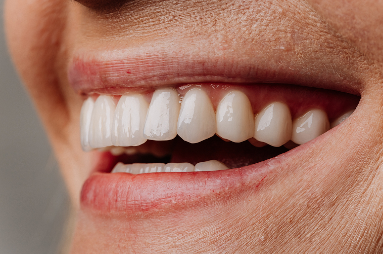 Cosmetic dentistry smile transformation at Trusted Dental Hawthorne CA