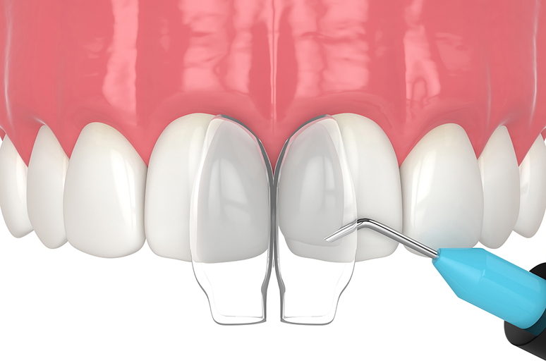 Dental bonding before and after Trusted Dental Hawthorne CA