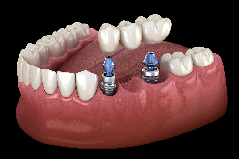 Dental bridge process at Trusted Dental Hawthorne