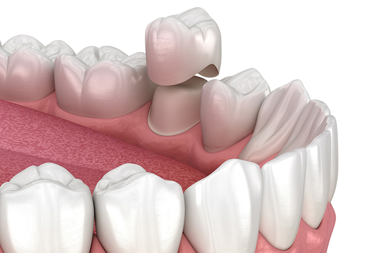 Same-day CEREC dental crown at Trusted Dental Hawthorne CA
