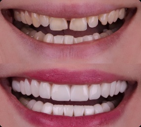 Veneer and whitening smile transformation