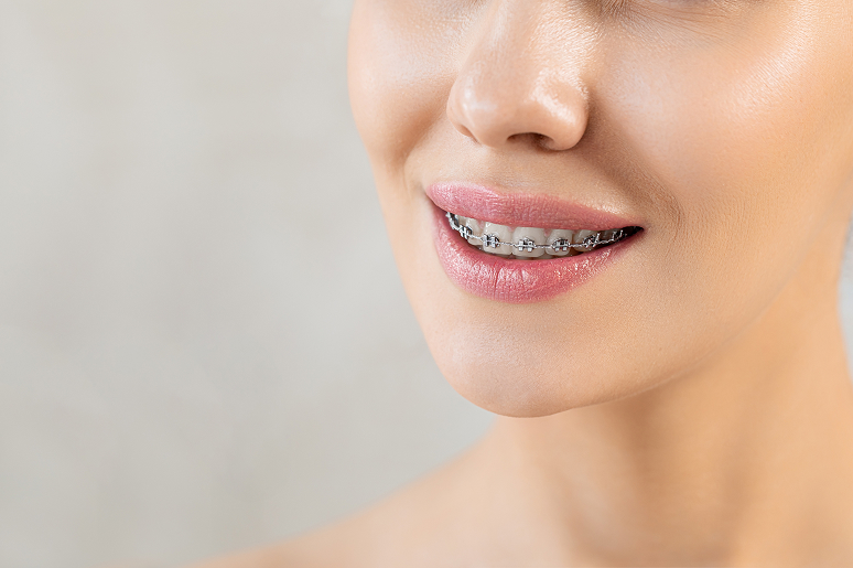 Metal braces treatment at Trusted Dental Hawthorne CA