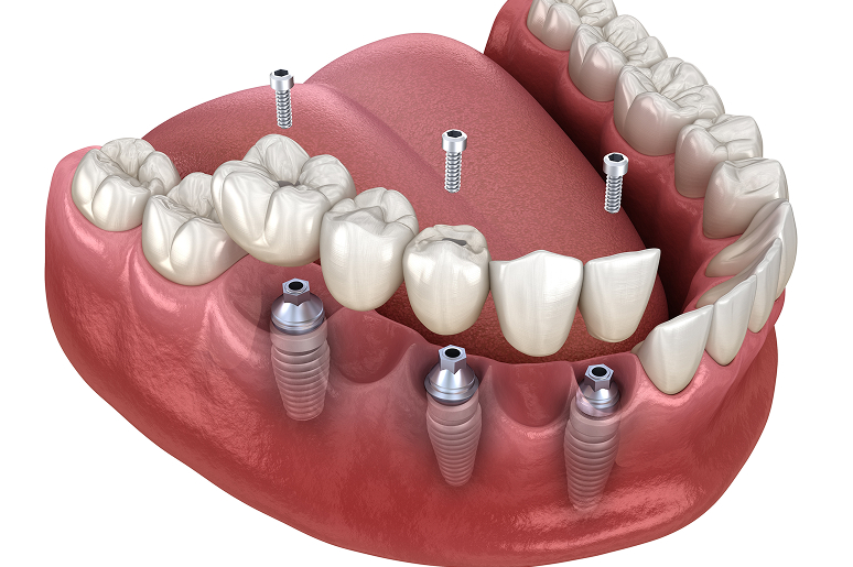 Multiple tooth implants Hawthorne CA