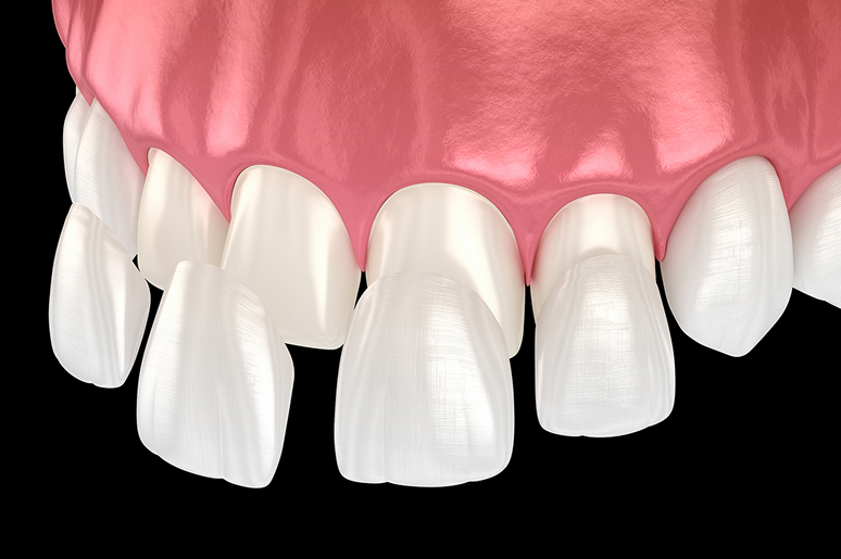 Porcelain veneers before and after Trusted Dental Hawthorne