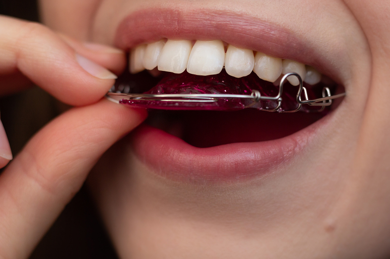 Orthodontic retainers Hawthorne CA Trusted Dental