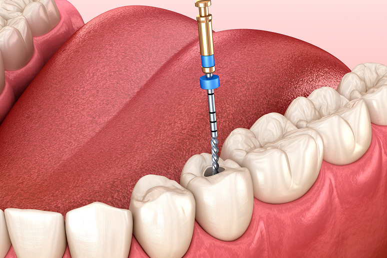 Root canal procedure steps at Trusted Dental