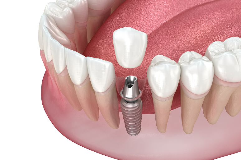 Single tooth dental implant in Hawthorne CA