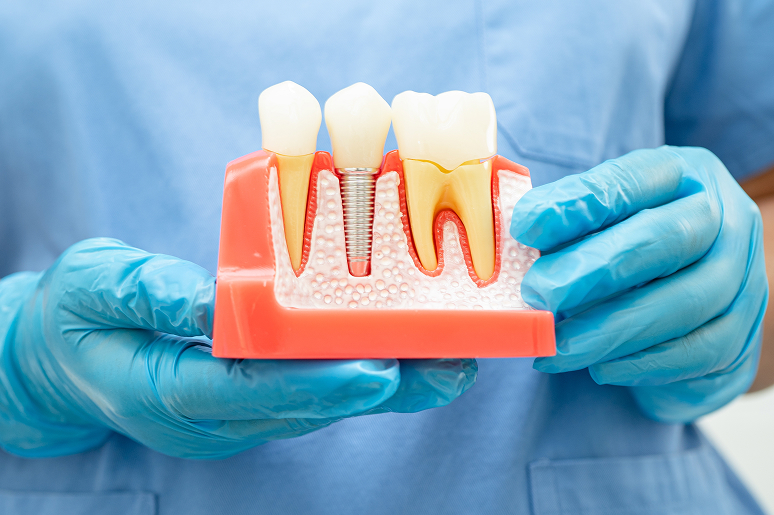 Dental implant vs dental bridge comparison