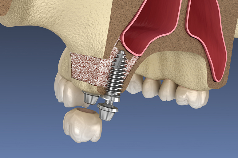 Sinus lift surgery for dental implants Hawthorne CA
